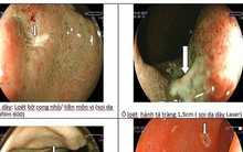 Loét dạ dày không điều trị có thể thành ung thư: Chuyên gia mách cách sống chung với bệnh