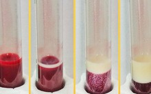 Đi xét nghiệm, sau 15 phút máu biến thành màu vàng: Lời cảnh báo các "tiên tửu" dịp Tết