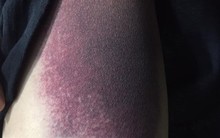 Bệnh nhân bị chấn thương ở háng, rách cơ vì tập yoga theo tư thế này: Lời cảnh báo không thừa từ bác sĩ