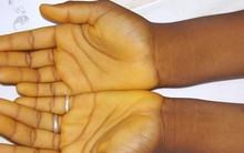 Hoảng hốt tưởng con bị bệnh gan vì da vàng như nghệ: Nguyên nhân khiến nhiều mẹ bất ngờ