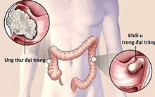 Căn bệnh ung thư này ngày một gia tăng ở người trẻ tuổi: Những lưu ý cần biết để bảo vệ mình