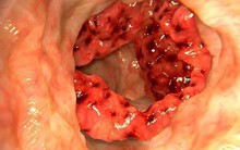 Ung thư đại trực tràng: Người và nghề nào sẽ có nguy cơ mắc bệnh cao?