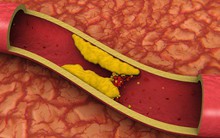 Dấu hiệu nguy hiểm cảnh báo tắc nghẽn động mạch: Nhận biết sớm, nguy cơ bị đột quỵ sẽ giảm