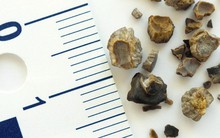 Muốn loại bỏ sỏi thận triệt để: Quan trọng nhất là "giữ mồm giữ miệng" trước những món này