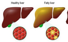6 bài tập giúp cải thiện chức năng gan: Nên tập mỗi ngày để gan hoạt động hiệu quả hơn