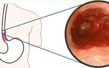 BS phát hoảng vì bệnh nhân nôn hàng lít máu tươi: "Thủ phạm" là thứ đồ uống nhiều người mê