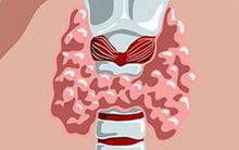 Những thực phẩm gây hại đối với người mắc bệnh tuyến giáp