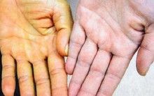 Thấy cơ thể có 3 bộ phận này chuyển sang màu vàng thì coi chừng bạn đang bị ung thư