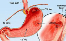 Dấu hiệu sớm của ung thư dạ dày: Nếu biết để phát hiện kịp thời, cơ hội khỏi bệnh rất cao