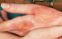 Từ hình ảnh dùng kem đánh răng chữa bỏng khiến bàn tay sưng phồng nghiêm trọng, bác sĩ khuyến cáo việc nên làm khi bị bỏng