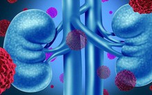 GS y khoa khuyến cáo: "Khi bạn càng có tiền, điều kiện sống tốt, càng dễ bị ung thư thận"