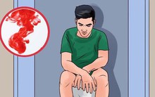 3 dấu hiệu mà nhiều người thường nhầm lẫn giữa bệnh ung thư ruột và bệnh trĩ