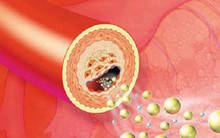 Căn bệnh có dấu hiệu mù mờ nhưng biến chứng cực nguy hiểm nhiều người Việt còn trẻ đã mắc