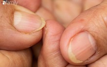 Móng tay vàng là dấu hiệu cảnh báo những vấn đề sức khỏe nghiêm trọng này
