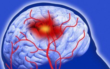 3 nhóm người dễ bị bệnh đột quỵ "gọi tên": Hãy khẩn trương thay đổi để tránh rủi ro