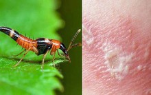 Kiến ba khoang tấn công, độc tố mạnh gấp 12-15 lần rắn hổ mang: Đây là cách xử lý ĐÚNG NHẤT bác sĩ khuyên làm