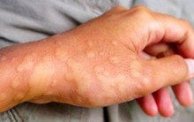 Dị ứng thời tiết: Tình trạng rất dễ gặp phải khi trời chuyển lạnh, nhưng không phải ai cũng biết cách chữa trị