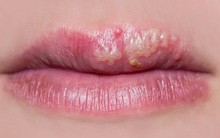 Zona thần kinh trên miệng: căn bệnh thường gặp khi trời hanh khô khiến không ít nàng cảm thấy ái ngại