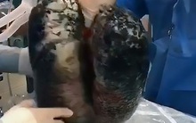 Nhìn hình ảnh 2 lá phổi đen kịt này chắc chắn những người nghiện thuốc lá nặng cũng muốn từ bỏ ngay lập tức