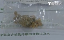 Mỗi tuần uống 1 chai nước, lại không ăn sáng, cô bé 10 tuổi phải vào viện phẫu thuật vì căn bệnh này