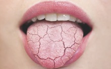 Uống nước nhiều nhưng vẫn thấy khô miệng, hãy cẩn thận bởi đây là dấu hiệu của hàng loạt bệnh nguy hiểm