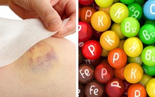 Đừng chủ quan với những vết bầm bất thường trên cơ thể, 7 vấn đề sức khỏe này có thể liên quan