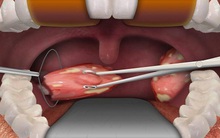 Bé gái 7 tuổi tử vong chỉ sau vài phút phẫu thuật cắt amidan, chuyên gia đưa ra một loạt cảnh báo