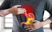 Trào ngược dạ dày - thực quản không xử lý kịp thời có thể cực kỳ nguy hiểm: Bác sĩ BV K chỉ ra 1 điều rất quan trọng nếu muốn điều trị thành công