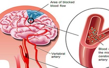 Căn bệnh "sát thủ" có thể gây suy tim, đột quỵ, suy thận: Nguy hiểm nhưng khó phát hiện