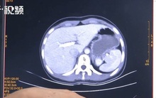 Cô bé 14 tuổi đã mắc hội chứng thường gặp ở những người khoảng 30 tuổi, cứ uống nước vào là no, ăn vào là nôn ói