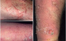 Cảnh báo mới về sự nguy hiểm của kiến ba khoang