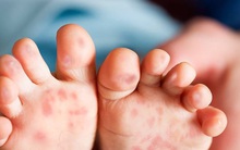 Hiện đang có dịch tay chân miệng, hãy nắm rõ 6 lưu ý của Bộ Y tế để phòng tránh và nhận biết bệnh kịp thời