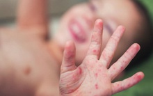 Sốt cao không hạ: BS Bệnh viện Nhi khuyến cáo có thể là dấu hiệu tay-chân-miệng nặng