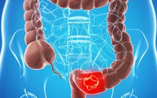 Những người có nguy cơ và nguy cơ cao mắc ung thư đại trực tràng: Đừng lơ là tầm soát!