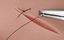 Phát hiện gây sững sờ: Các vết thương sẽ lành nhanh như “tốc độ ánh sáng” nhờ loại chỉ phẫu thuật làm từ… da người