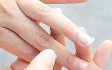 5 đặc điểm lạ xuất hiện trên bàn tay có thể là tín hiệu cảnh báo nguy cơ mắc bệnh xơ gan