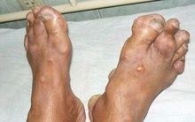 Căn bệnh "vua của đau" già, trẻ, giàu, nghèo đều có thể mắc: Bệnh có liên quan đến ăn uống