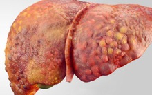 Chuyên gia ung bướu: "Bí quyết" 1 cần, 2 không, 1 ít "chặn đứng" căn bệnh ung thư nguy hiểm