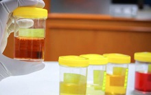 Thấy nước tiểu luôn có màu vàng sẫm: chưa chắc là cảnh báo thận yếu, nguyên nhân có thể do những điều khác