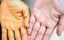 Gan là nhà máy giải độc và bài tiết chất có hại: Có 7 dấu hiệu sau là gan đang kêu cứu