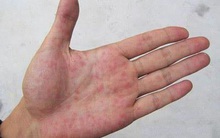 Cơ thể xuất hiện "1 đỏ, 2 vàng, 1 đen": Dấu hiệu mắc ung thư gan