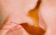 Đau tai dữ dội dù bơi ở bể 5 sao: Bác sĩ chỉ 3 căn bệnh phổ biến do hoá chất bể bơi gây ra