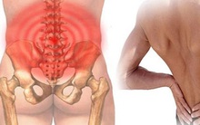 Bệnh đau lưng tấn công người trẻ nặng nề: 4 hành vi nhỏ bạn đang làm sai gây hậu quả