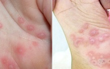 2 dấu hiệu biến chứng cực kỳ nguy hiểm của bệnh tay chân miệng cha mẹ cần nắm để theo dõi kỹ