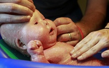 Trong 2 tuần, Việt Nam có tới 2 bé sơ sinh mắc da vảy cá: Căn bệnh này nghiêm trọng thế nào?