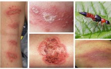 Kiến ba khoang: Độc tố nặng hơn rắn hổ, có thể gây biến chứng nặng, làm sao để tránh bị "tấn công"?