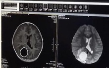 Sốc khi bé 8 tuổi bị phẫu thuật não do sâu răng, chuyên gia chỉ rõ cảnh giác với căn bệnh tưởng đơn giản này