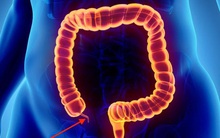 Đau bụng kèm sốt, chán ăn: Cẩn thận với căn bệnh có "thời gian vàng" cấp cứu chỉ 6 giờ, để lâu nhiều biến chứng