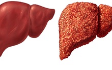 3 điều nên làm ngay để ngăn chặn xơ gan: Người có vấn đề về gan nên lưu ý sớm