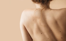 Da đồi mồi xuất hiện khi chúng ta bao nhiêu tuổi? Nếu làm tốt 4 điều này, bạn sẽ không phải lo về đốm đồi mồi nữa